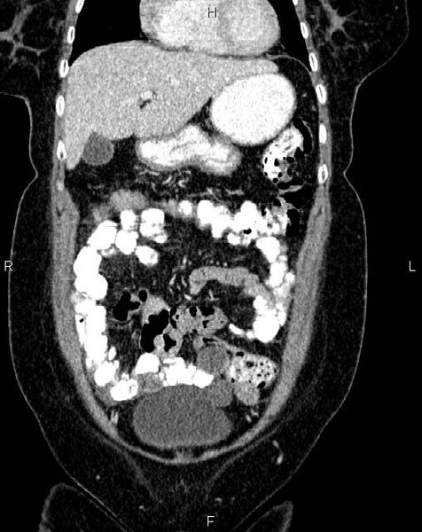 File:Bilateral ovarian serous cystadenocarcinoma (Radiopaedia 86062-101989 D 7).jpg