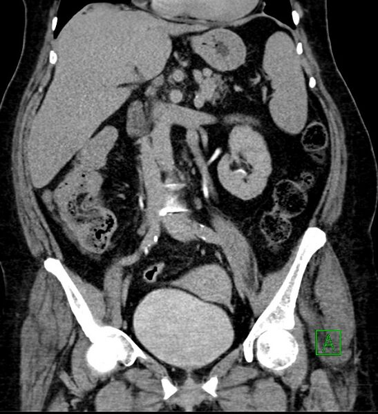 File:Bilateral sporadic synchronous clear cell renal cell carcinoma (Radiopaedia 85035-100575 I 26).jpg