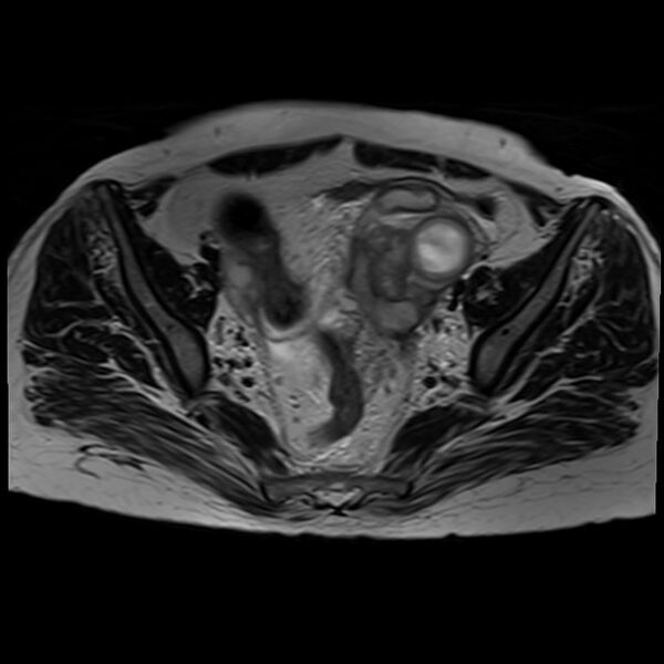 File:Bilateral tubo-ovarian abscesses (Radiopaedia 58635-65829 Axial T2 19).jpg