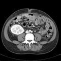Biliary necrosis - liver transplant (Radiopaedia 21876-21846 B 46).jpg