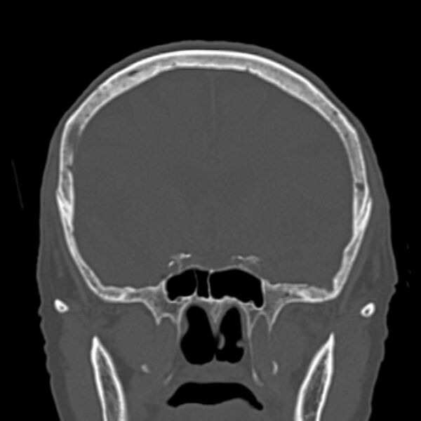File:Biparietal osteodystrophy (Radiopaedia 46109-50463 Coronal bone window 44).jpg