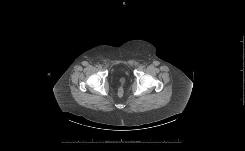 File:Bladder exstrophy - post surgery (Radiopaedia 35763-37314 Axial non-contrast 1).jpg