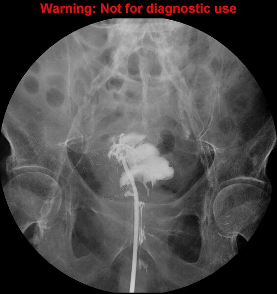 File:Bladder rupture (intraperitoneal) (Radiopaedia 41057-43807 cystogram 4).jpg