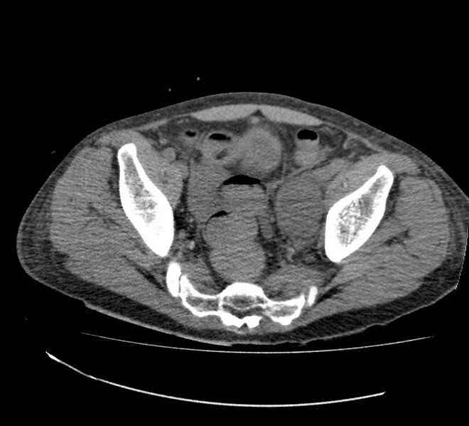 File:Bowel lymphoma complicated by bleeding after therapy (Radiopaedia 55601-62110 Axial non-contrast 70).jpg