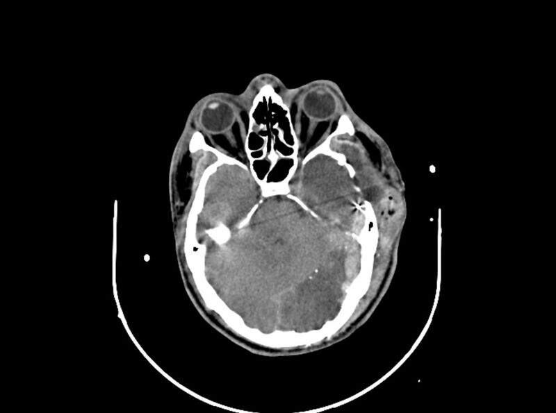 File:Brain injury by firearm projectile (Radiopaedia 82068-96087 B 77).jpg