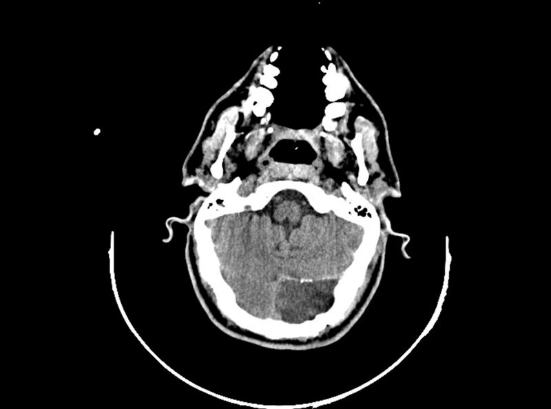 File:Brain injury by firearm projectile (Radiopaedia 82068-96088 A 73).jpg