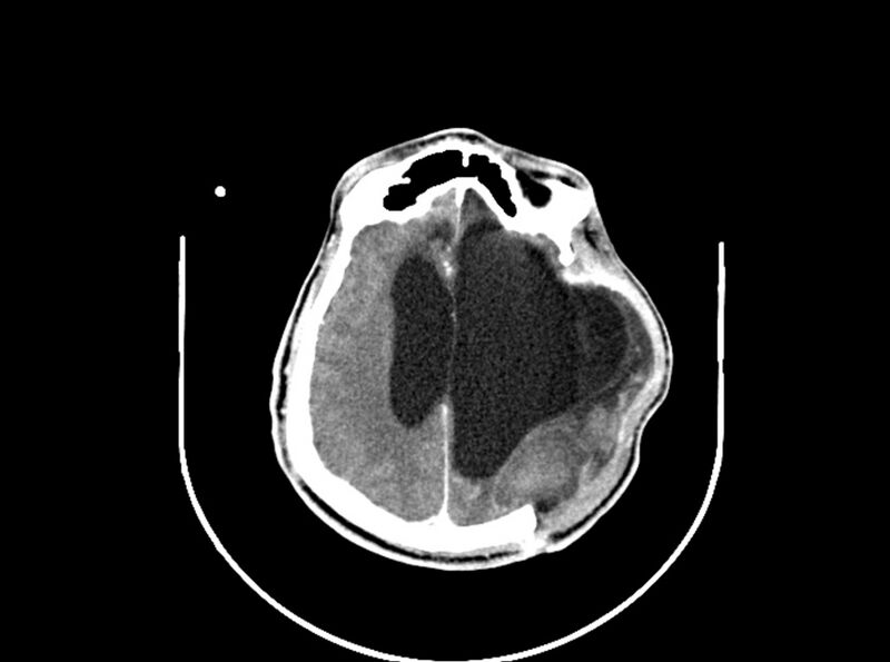 File:Brain injury by firearm projectile (Radiopaedia 82068-96088 B 149).jpg