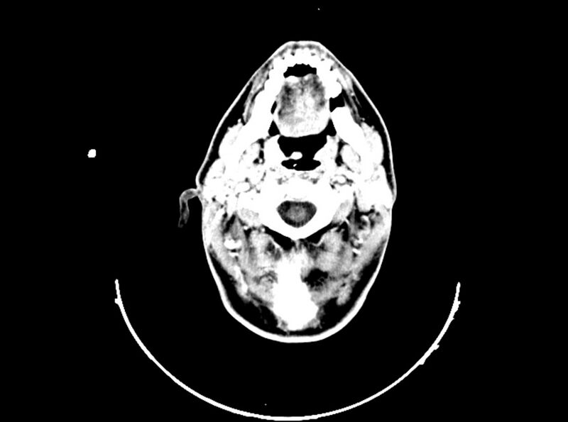 File:Brain injury by firearm projectile (Radiopaedia 82068-96088 B 51).jpg