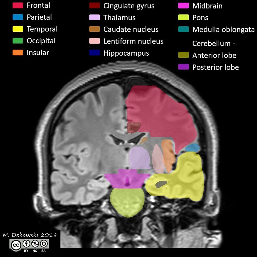 Brain lobes - annotated MRI (Radiopaedia 61691-69700 Coronal 36).JPG