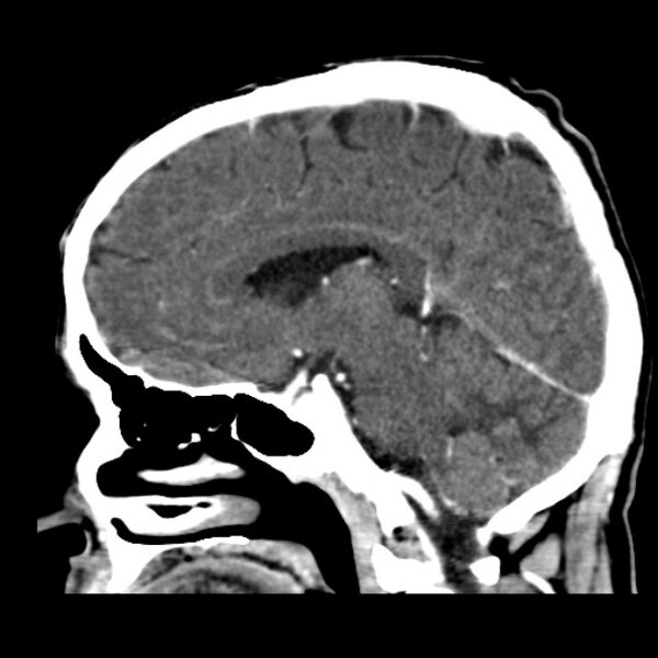 File:Brain metastases from lung cancer (Radiopaedia 24480-24781 C+ delayed 27).jpg