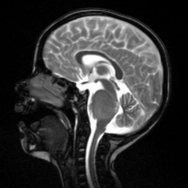 File:Brainstem glioma (Radiopaedia 5683-7390 Sagittal T2 1).jpg