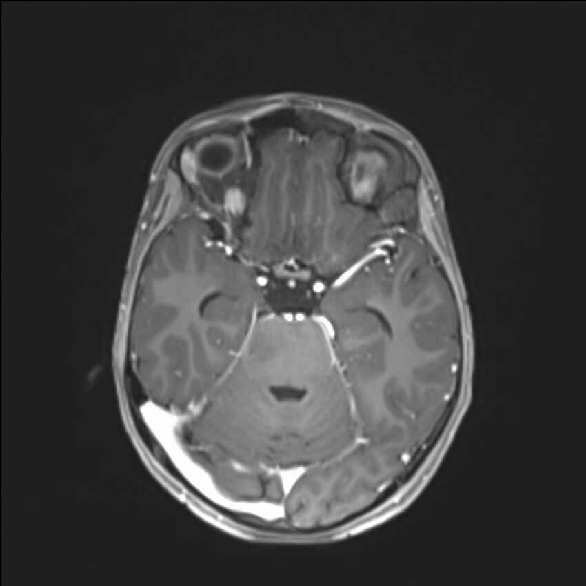 Brainstem glioma (Radiopaedia 70548-80674 Axial T1 C+ 62).jpg