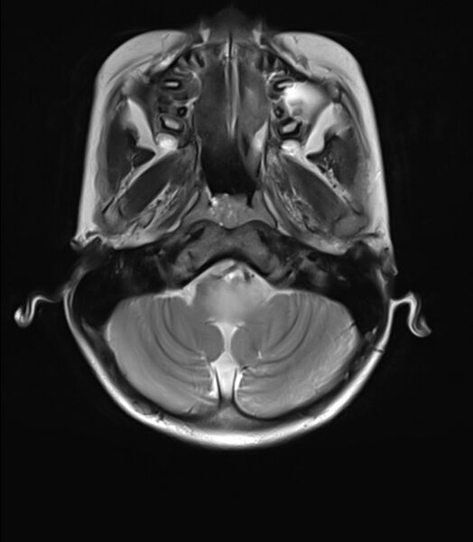 File:Brainstem glioma (Radiopaedia 70548-80674 Axial T2 4).jpg