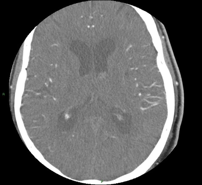File:Brainstem hemorrhage (Radiopaedia 58794-66028 D 107).jpg