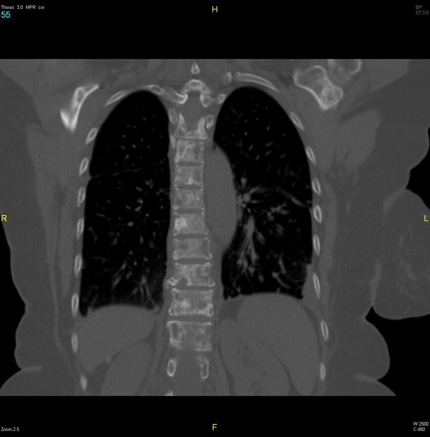Breast primary with lung and bone metastases (Radiopaedia 40620-43228 bone window 55).jpg
