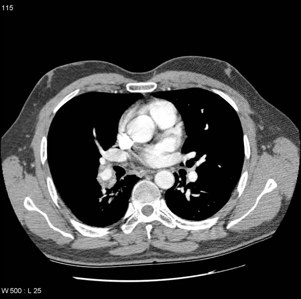 File:Bronchial arterial aneurysm (Radiopaedia 22293-22330 A 8).jpg