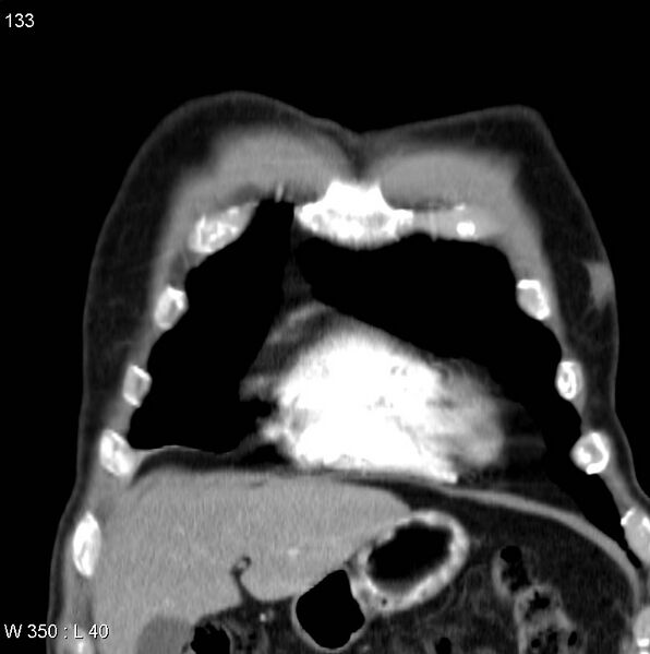File:Bronchial carcinoid tumor with right lower lobe collapse (Radiopaedia 29060-29422 C 2).jpg