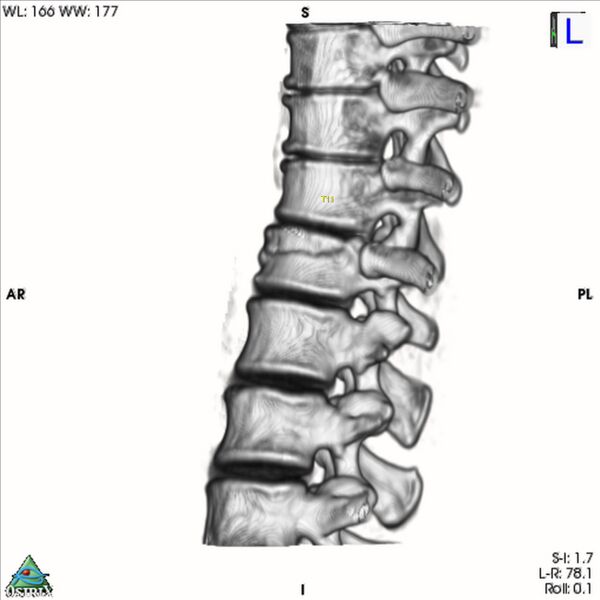 File:Bulging of paraspinal line in traumatic thoracal spinal compression fracture (Radiopaedia 29221-35872 3D VR 21).jpg
