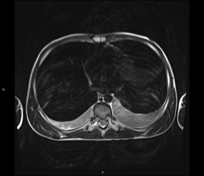 File:Burkitt lymphoma (bowel) (Radiopaedia 68839-78557 Axial T2 1).jpg