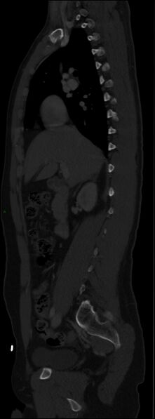 File:Burst fracture (Radiopaedia 83168-97542 Sagittal bone window 56).jpg