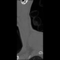 C5 facet fracture (Radiopaedia 58374-65499 Sagittal bone window 68).jpg