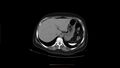 Calcified spleen (Radiopaedia 60952-68768 Axial non-contrast 3).jpg