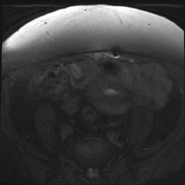 File:Cancer cervix - stage IIb (Radiopaedia 75411-86615 T1 fat sat 27).jpg
