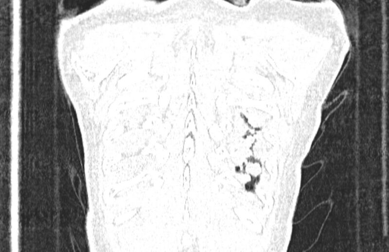 File:Cannonball metastases from breast cancer (Radiopaedia 91024-108569 Coronal lung window 137).jpg