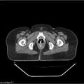 Carcinoma cervix- brachytherapy applicator (Radiopaedia 33135-34173 Axial non-contrast 45).jpg