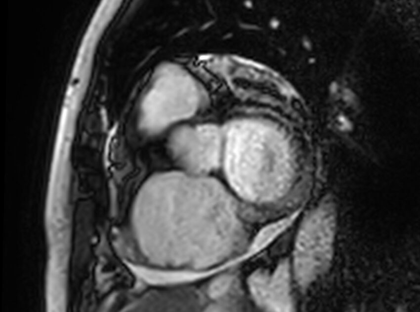 Cardiac amyloidosis (Radiopaedia 61600-69579 Short axis bSSFP 319).jpg