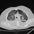 Cardiogenic pulmonary edema (Radiopaedia 29213-29609 Axial lung window 26).jpg