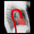Cardiomediastinal anatomy on chest radiography (annotated images) (Radiopaedia 46331-50748 N 1).png