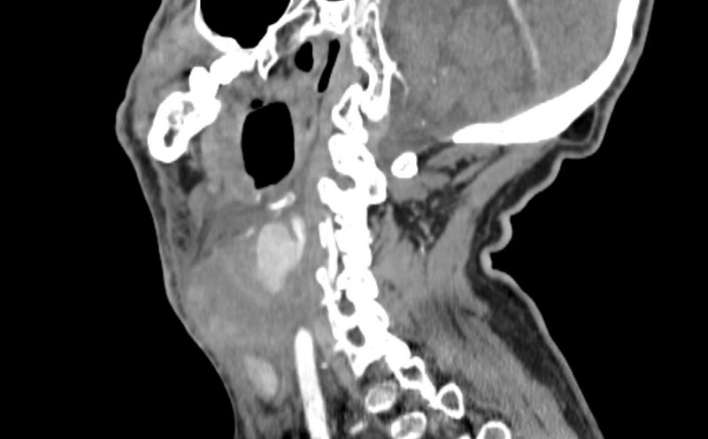 File:Carotid artery pseudoaneurysm (Radiopaedia 84030-99259 E 19).jpg