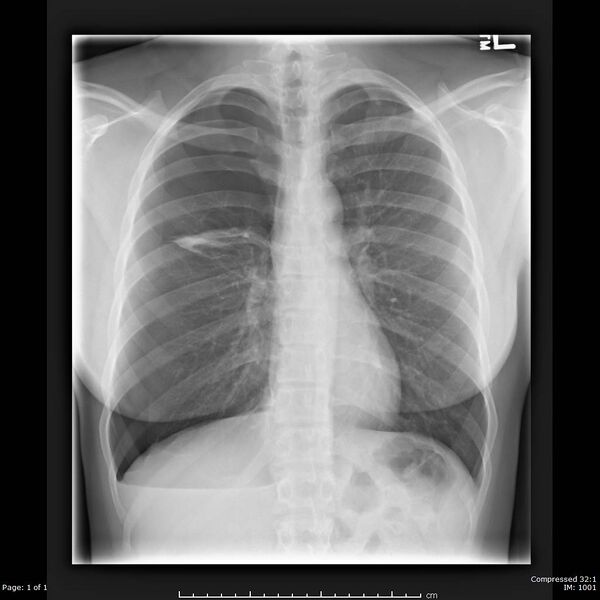 File:Catamenial pneumothorax (Radiopaedia 54382-60601 Frontal 1).jpg
