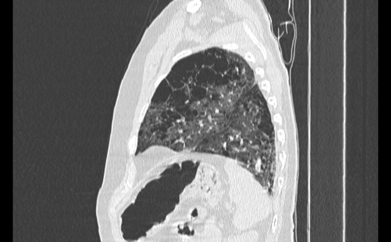 File:Cavitating bronchogenic carcinoma (Radiopaedia 44489-48162 Sagittal lung window 55).jpg