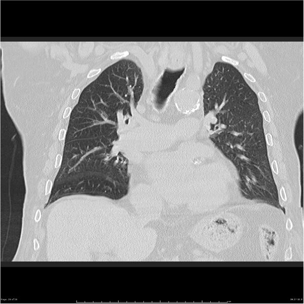 File:Cavitating left lower lobe lesion - squamous cell lung cancer (Radiopaedia 27749-28176 Coronal lung window 26).jpg