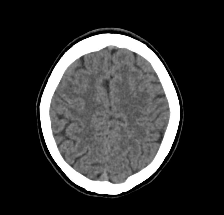 Cerebellar agenesis (Radiopaedia 30203-30817 Axial non-contrast 39).jpg