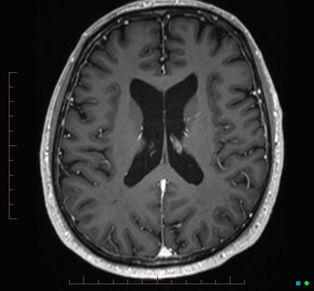 File:Cerebellar gangliocytoma (Radiopaedia 65377-74422 Axial T1 C+ 80).jpg