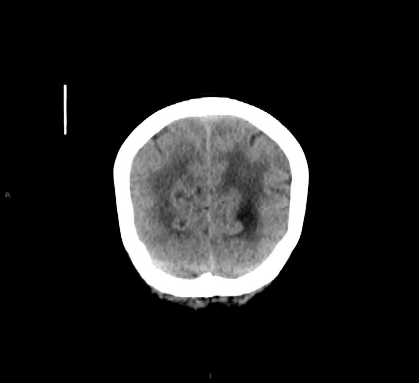 Cerebellar hemorrhage (Radiopaedia 58793-66027 Coronal non-contrast 16).jpg