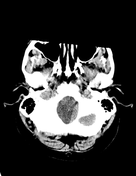 File:Cerebellar infarct due to vertebral artery dissection with posterior fossa decompression (Radiopaedia 82779-97030 Axial non-contrast 6).png