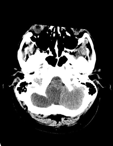 File:Cerebellar infarct due to vertebral artery dissection with posterior fossa decompression (Radiopaedia 82779-97030 Axial non-contrast 7).png