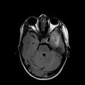 Cerebral abscess post cardiac surgery (Radiopaedia 27244-27420 Axial FLAIR 7).jpg