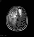 Cerebral abscesses secondary to contusions (Radiopaedia 5201-6968 Axial FLAIR 6).jpg