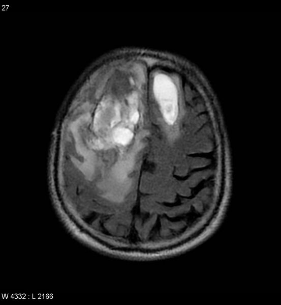 File:Cerebral abscesses secondary to contusions (Radiopaedia 5201-6968 Axial FLAIR 6).jpg