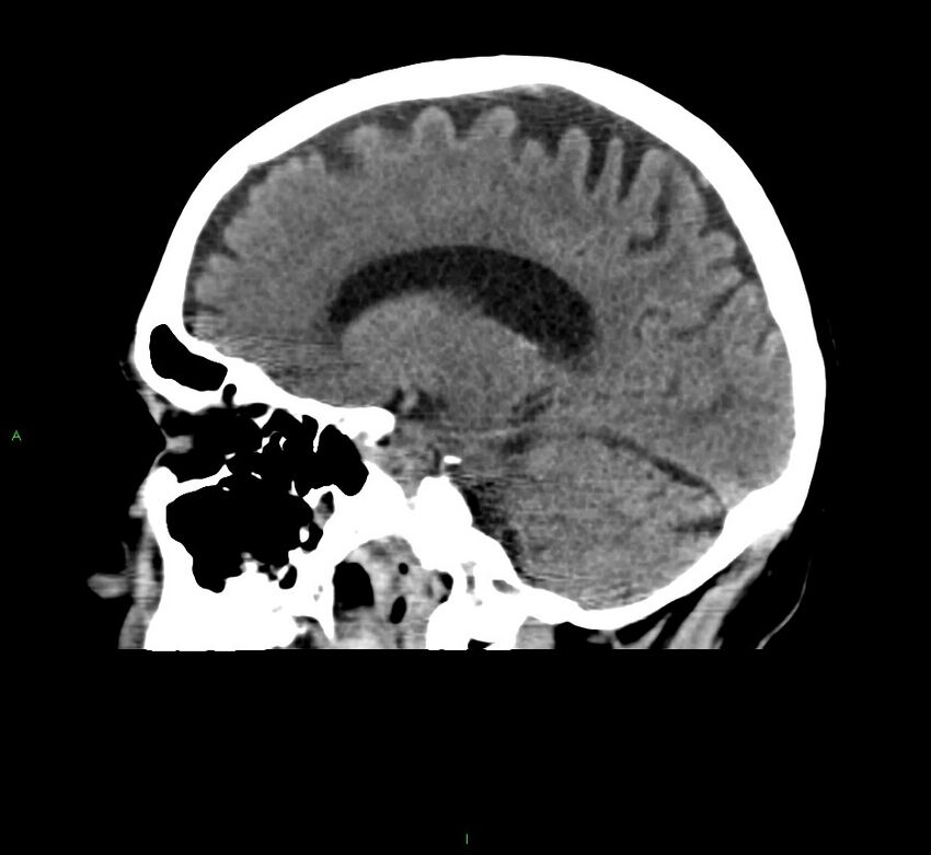 Cerebral amyloid angiopathy-associated lobar intracerebral hemorrhage (Radiopaedia 58376-65511 C 22).jpg