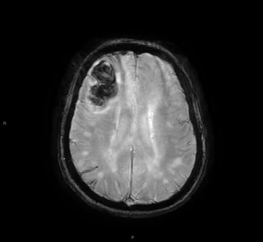 Cerebral amyloid angiopathy-associated lobar intracerebral hemorrhage (Radiopaedia 58378-65517 Axial SWI 48).jpg