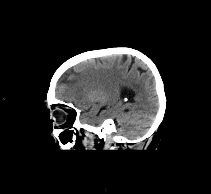 Cerebral amyloid angiopathy-associated lobar intracerebral hemorrhage (Radiopaedia 58529-65681 B 16).jpg
