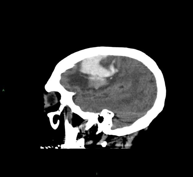 File:Cerebral amyloid angiopathy-associated lobar intracerebral hemorrhage (Radiopaedia 58560-65723 C 12).jpg