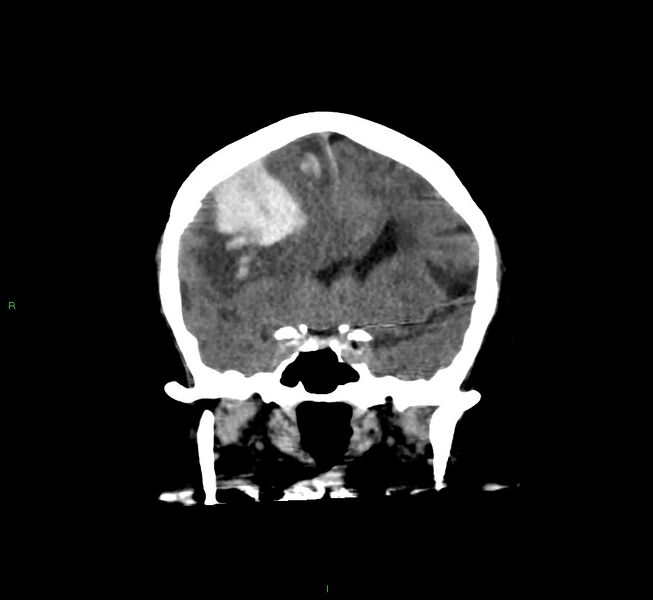 File:Cerebral amyloid angiopathy-associated lobar intracerebral hemorrhage (Radiopaedia 58560-65723 Coronal non-contrast 45).jpg