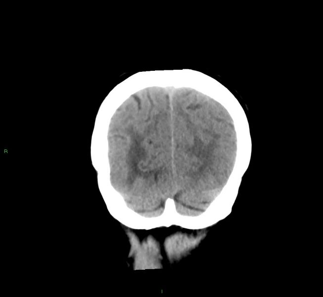 File:Cerebral amyloid angiopathy-associated lobar intracerebral hemorrhage (Radiopaedia 58561-65724 Coronal non-contrast 13).jpg